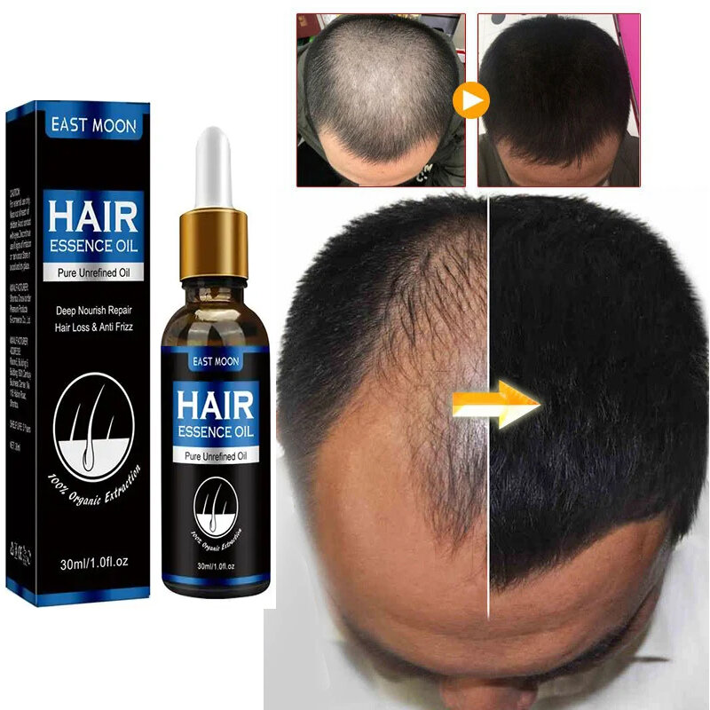 Olio per capelli a crescita rapida riparazione efficace calvizie bulbi per capelli perdita di capelli intrinseca perdita di capelli dopo il parto cura dei capelli seborroica