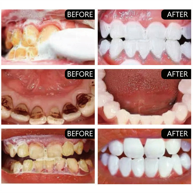 Dentes branqueamento pó para removedor de manchas de placa, creme dental, limpeza profunda, respiração fresca, higiene oral, Dental Care Tools, 5 dia