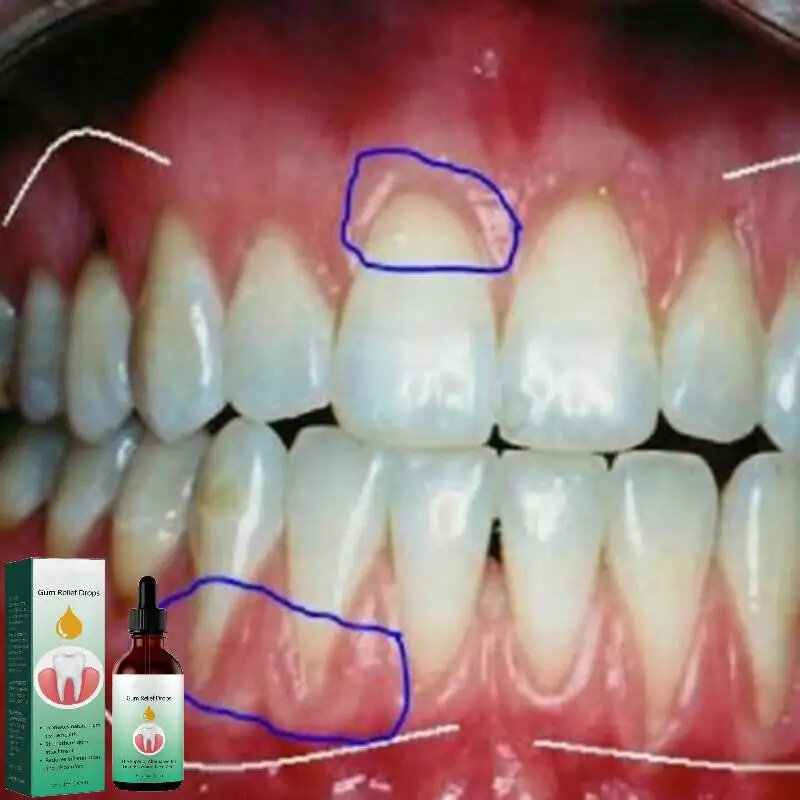 Tandvleesreparatie Druppels Verlichten Terugwijkende Tandvleeszwelling Tandvlees Reinigingszorg Orale Parodontale Hygiëne Verwijder Vlek Verwijder Gele Tandsteen