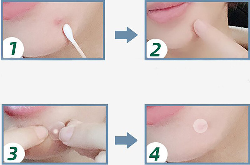 LEKGAVD-Parche Invisible para acné, mascarilla para el cuidado de la piel, corrector de manchas, removedor de espinillas, pegatinas, mascarillas para el cuidado de la piel