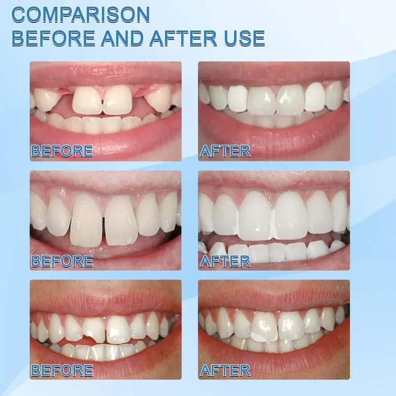 30Ml Resin ชั่วคราวฟันซ่อมเม็ดฟันช่องว่างหายไปหักฟันปลอมฟันบรรจุ Moldable กาวแข็งทันตกรรม Care