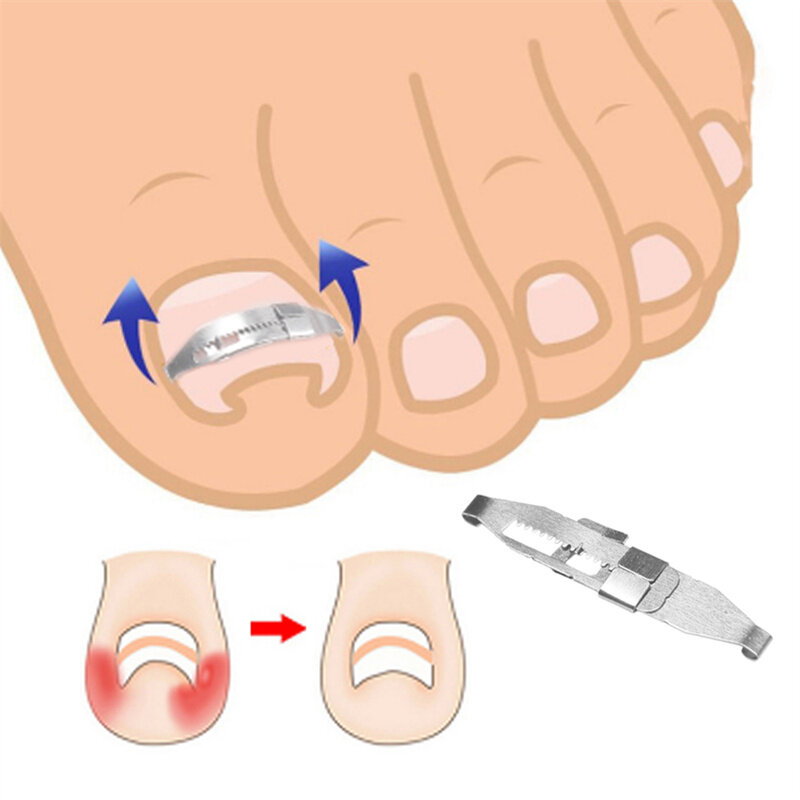 Инструмент для коррекции вросших ногтей на пальцах ног, корректоры для ногтей, набор инструментов для восстановления ортеза