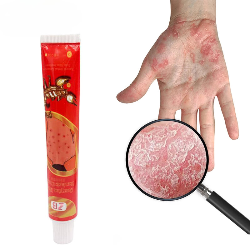 Herbal Antibacteriano Psoríase Creme, Pomada antibacteriana, Dermatite Eczematoid Eczema, Cuidados com a pele, Anti-inflamatório