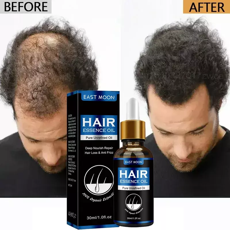Fast Hair Growth Oil, Reparação Eficaz da Calvície, Herbal Hair Loss, Anti-Queda Pós-parto, Seborréica, 30ml