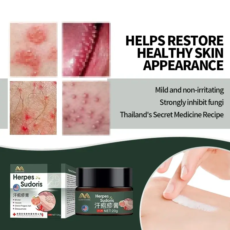 20g American Herpes Zoster Treatment Cream Snake Sore Red Dot Blister Herpes Simplex Ointment Shingles Cure Skin Medicine