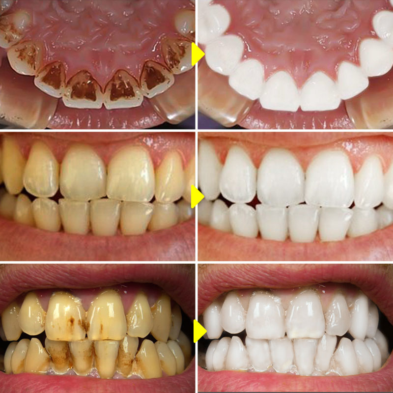 Entfernen Sie Plaque Flecken Serum gegen Zahnkaries Zahnzahn bauen starke Zähne aufhellen frischen Atem Mundhygiene Reinigungs werkzeuge