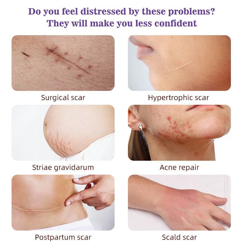 Scar Repair Serum Scar Tratamento Cirúrgico Cicatrizes Queimaduras Pele Trauma Acne Imprints Stretch Marks Fade Pigmentação Cuidados com a pele 30ml