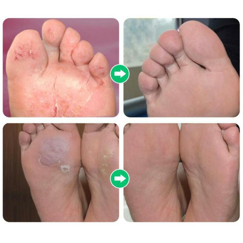 55ml Fußspray für Sportler Flüssigkeit stinkende Füße Spray Fuß spray für Frauen und Männer
