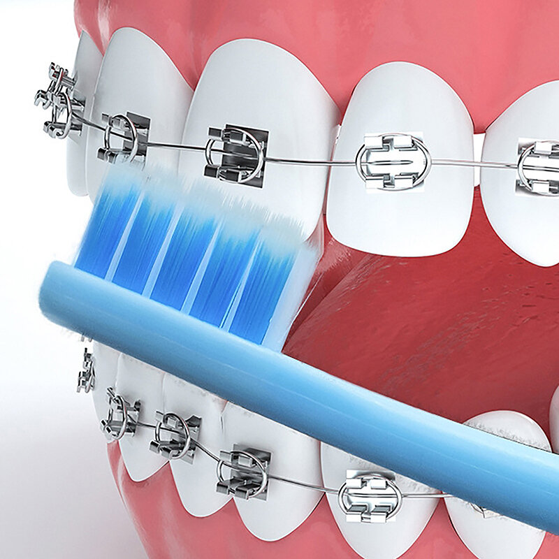 فرشاة أسنان مقعرة لتقويم الأسنان ، على شكل حرف U ، أسنان خاصة ، مشبك فراشي ، فرشاة أسنان للتنظيف ، ذكور وإناث ، 1 *