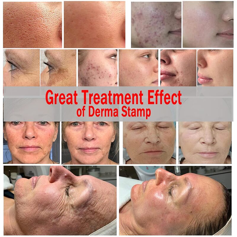 DRS 140A Derma Stamp Adjustable Microneedling for Face Body Care Hair Beard Growth Home Use Derma Rolling System