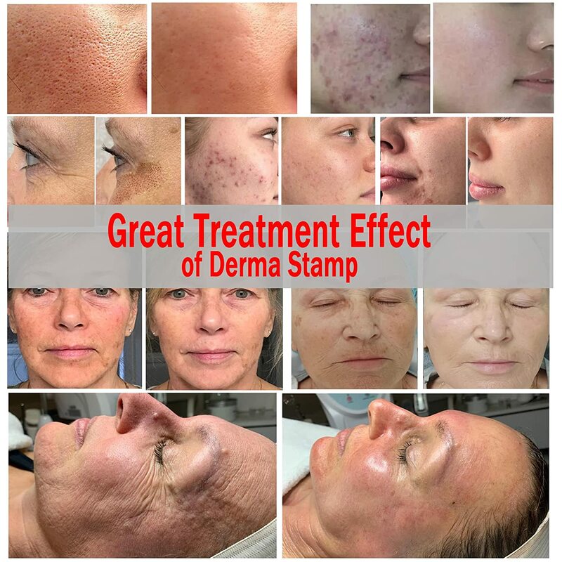 DRS 140A stempel kulit dapat diatur, jarum mikro untuk perawatan wajah tubuh pertumbuhan jenggot penggunaan rumah sistem penggulung kulit