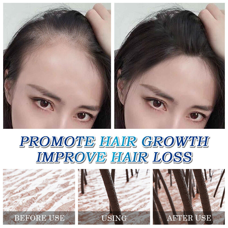 Productos para el crecimiento del cabello, aceite esencial Natural para el crecimiento rápido del cabello, reparación anticaída del cabello, tratamiento del cuero cabelludo dañado, cuidado de la salud, 32ml