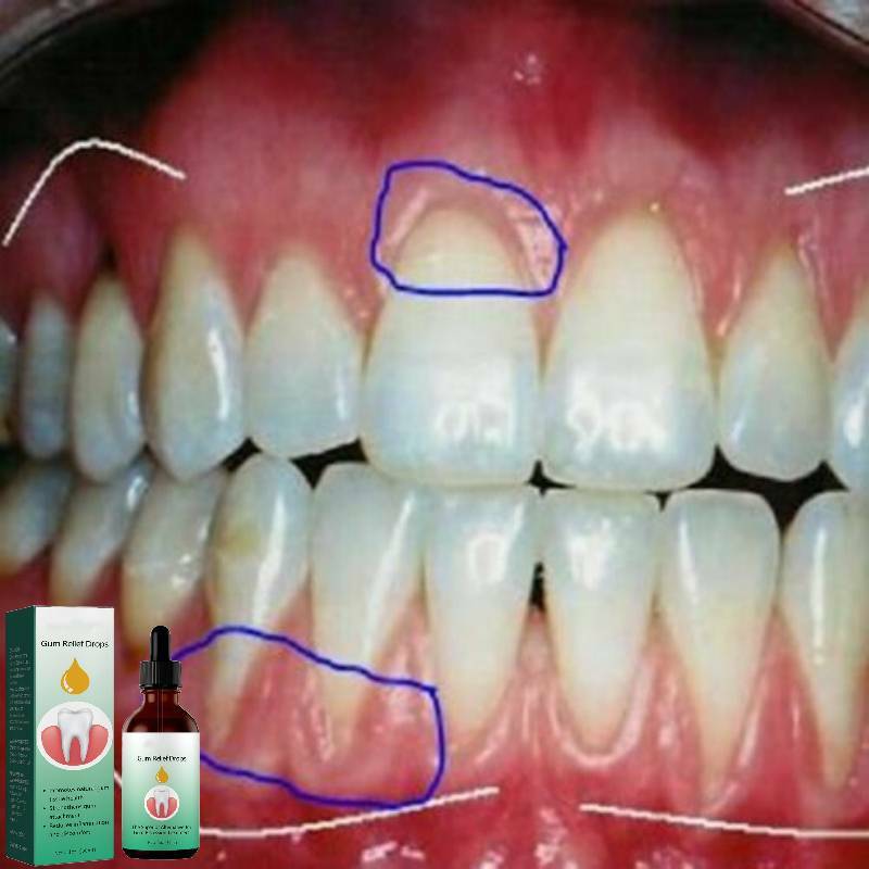 Tandvleesreparatie Druppels Verlichten Terugwijkende Tandvleeszwelling Tandvlees Reinigingszorg Orale Parodontale Hygiëne Verwijder Vlek Geel Serum
