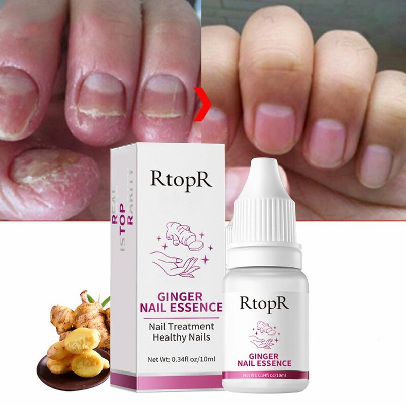 Nail Repair Essence Serum Fungal Nails Treatment Remover Onychomycosis Toe Nourishing Hand Foot Care Liquid Skin Care Tools