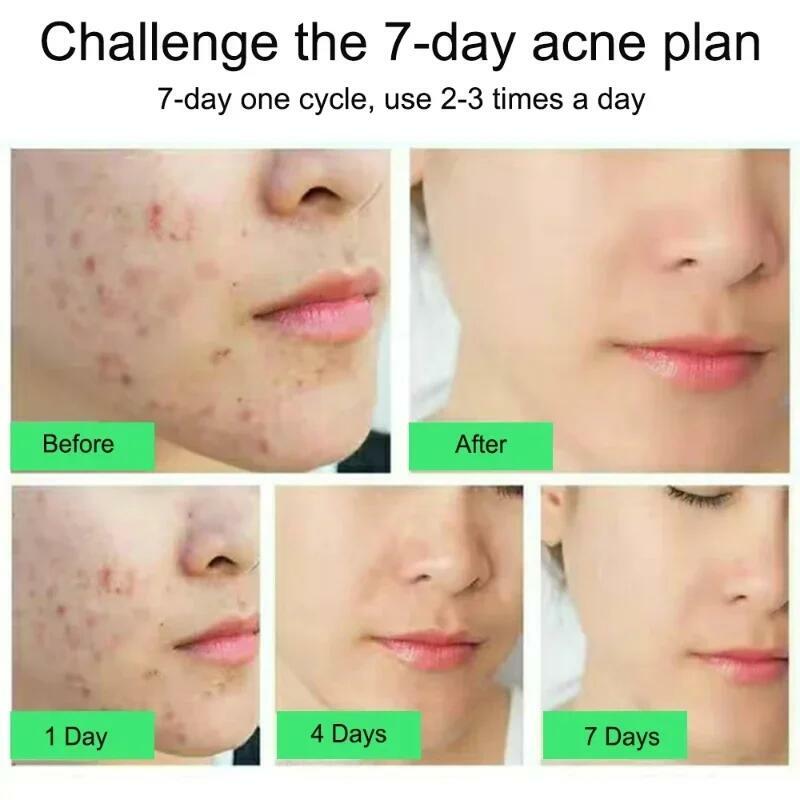 Salicylic Acid Acne Treatment Cream Repair Pimple Spots Deep Cleaning Pore Shrinking Anti-acne Oil Control Moisturizer Skin Care