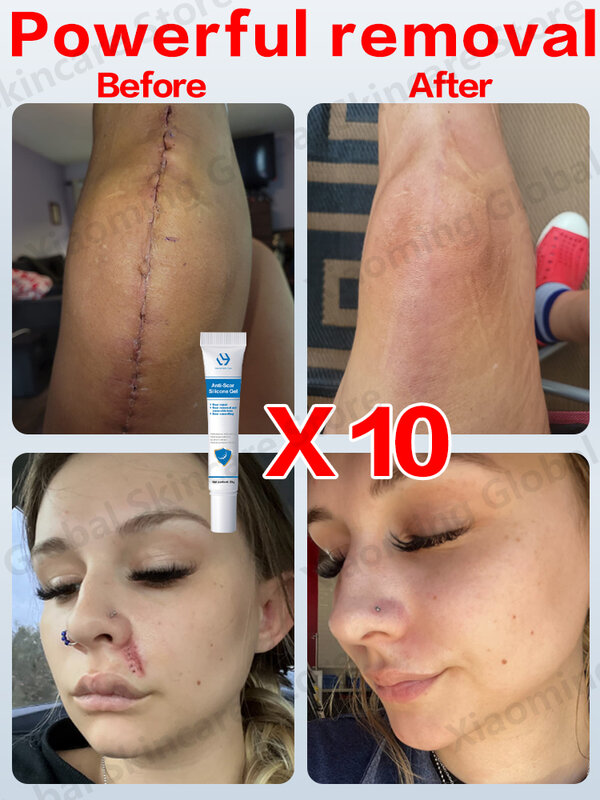 Scar Removal Cream for Old Scars Keloid Surgical Scar
