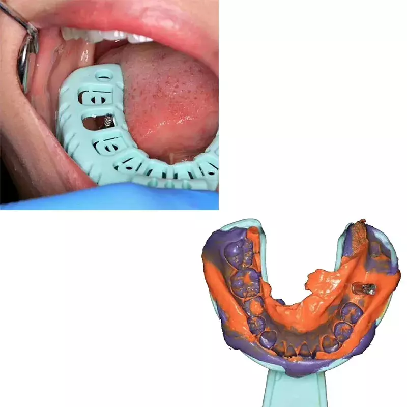 3 Đôi Cấy Ghép Răng Implant Khay Xanh Đầy Miệng Có Thể Tháo Rời Từng Phần Khuôn Khay Dễ Dàng Gấp Gọn Vách Ngăn Nhựa S/M/L