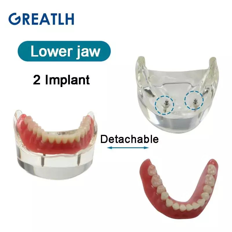 Dentes Dental Modelo com Implante Overdenture, Demo Inferior Modelo Mandibular, Estudante Aprendizagem Modelo