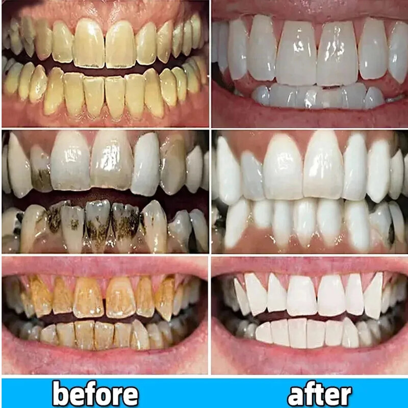 Whitening Teeth Toothpaste Dental Calculus Remover Serum Preventing Periodontitis Oral Odor Removal Cleansing Teeth Health Care
