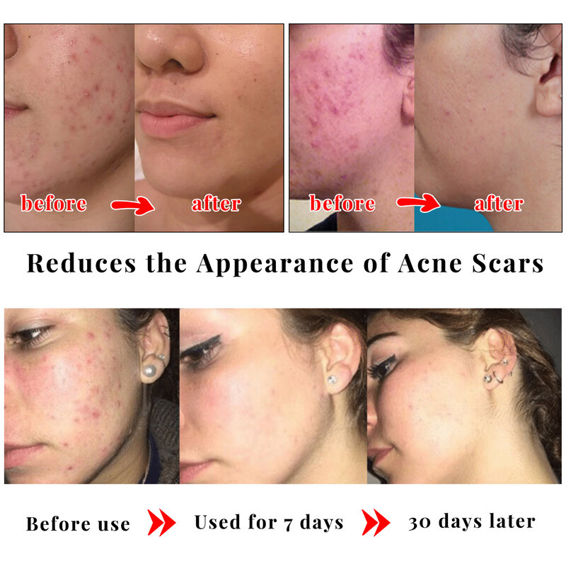 Kojic Acid Skin Care Set Facial Cleanser Body Lotion Handmade Soap Remove Dark Spots Whitening Anti Aging Remove Acne Body Care