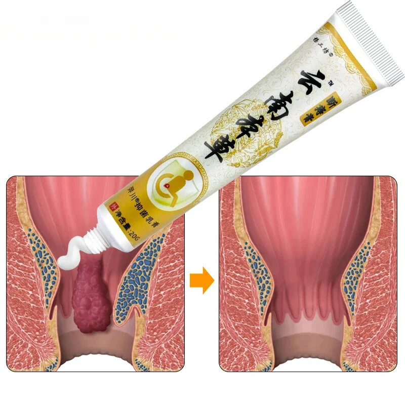 4 pezzi emorroidi unguento a base di erbe crema per la rimozione delle emorroidi crema per alleviare il dolore anale gonfiore anale antinfiammatorio lacrima anale S112
