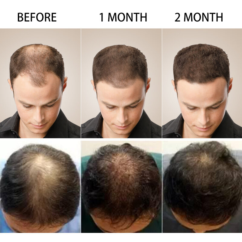 男性と女性のための成長血清,脱毛と損傷を防ぐための天然のヘアケア製品,30ml