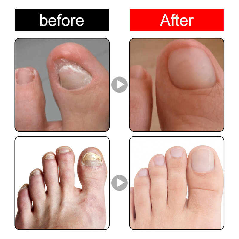 Outil de soins des pieds, réparation des ongles intérieurs, Essence, pédicure, blanchiment des ongles, huile essentielle Anti-fongique