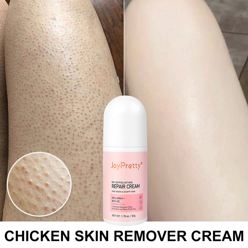 Body Cream Chicken Skin Removal Treatment Keratosis Pilaris Lotion Rough Bumpy Pore Spots Care Moisturizer Whitening Creams 60g
