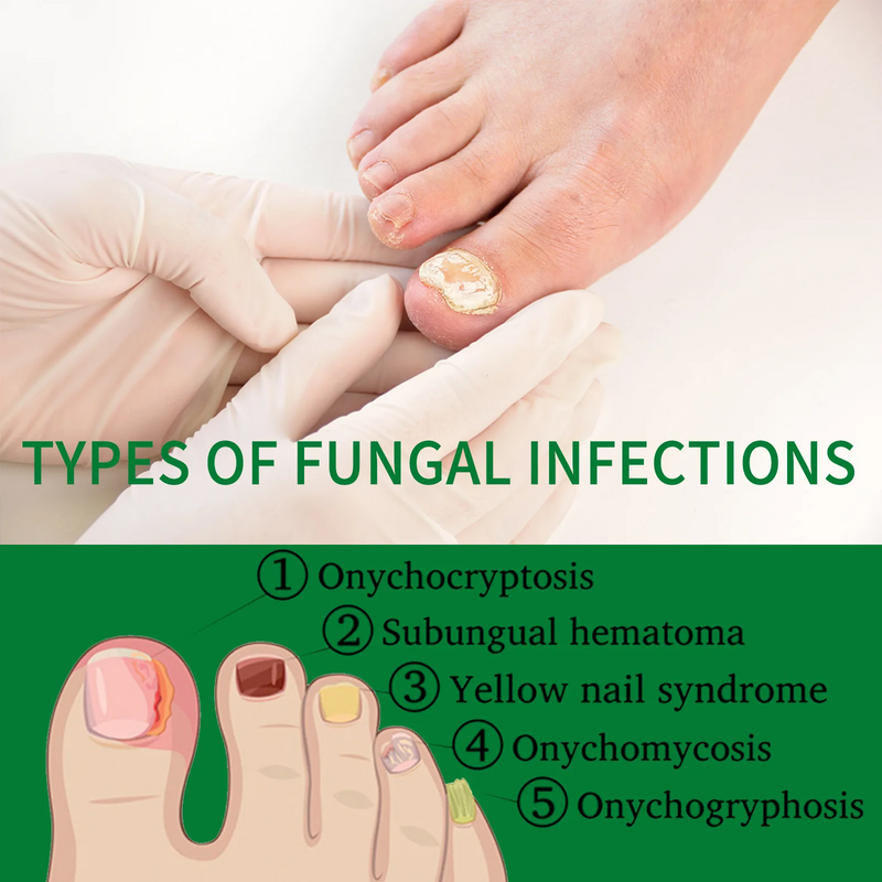 Trattamento antimicotico per unghie olio essenziale punta del piede siero per la rimozione dei funghi delle unghie 7 giorni ripara onicomicosi prodotti per la cura delle infezioni