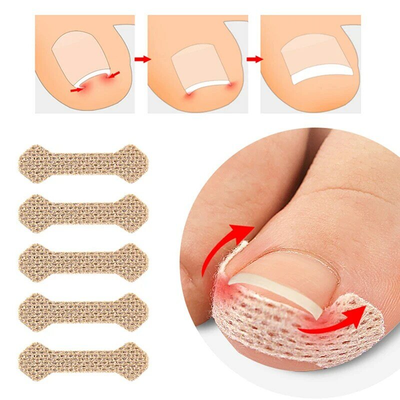 Parches de uñas para tratar la paroniquia con correctores de uñas y dispositivos de fijación para restaurar el cuidado de los pies de juanete