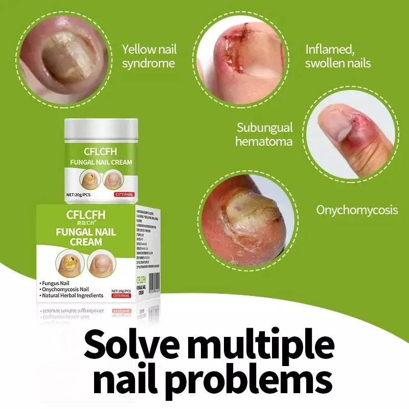 Fungal Nail Repair Cream Nail Correction Toe Fungus Treatment Gel Paronychia Onychomycosis Removal Anti Infection Foot Care