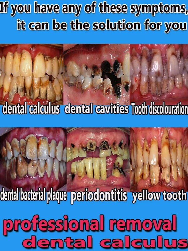Produkty do wybielania zębów w celu usunięcia kamienia nazębnego i nieświeżego oddechu
