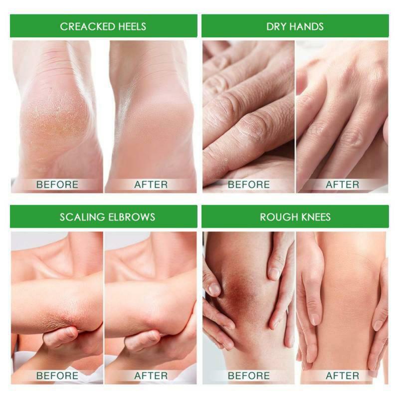 Crème réparatrice anti-séchage pour les pieds, 20g, élimination des fissures au talon, fréquence, soin de la peau, des mains et des pieds