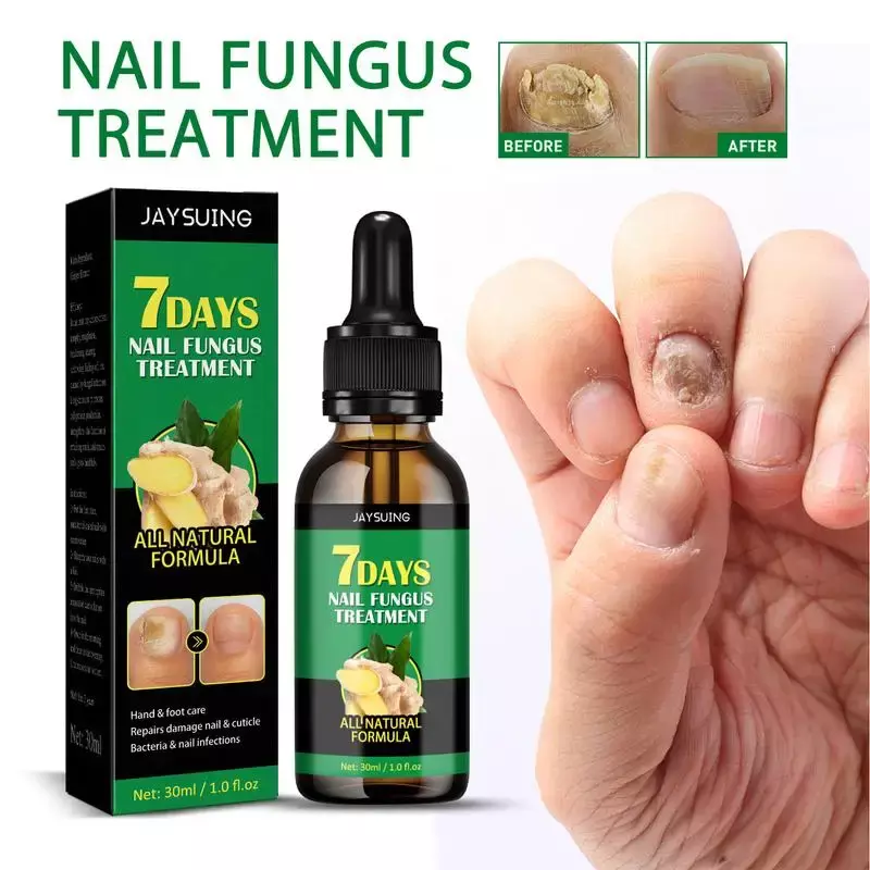 Tratamiento de uñas fungicida, aceite esencial, hongo de uñas, dispositivo láser para reparación de uñas de los pies, tratamiento de uñas, onicomicosis, 30ml