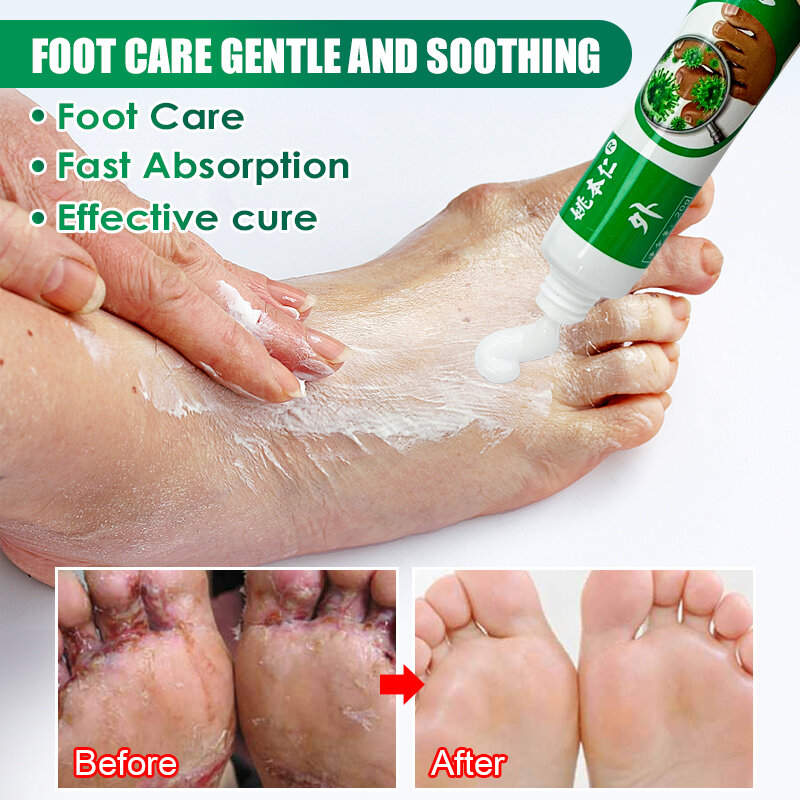 2Pcs Anti-fungal Foot Cream Herbal Athlete Foot Anti Itch Cream Remove Foot Corn Antibacterial Feet Care Beriberi Cream A1066