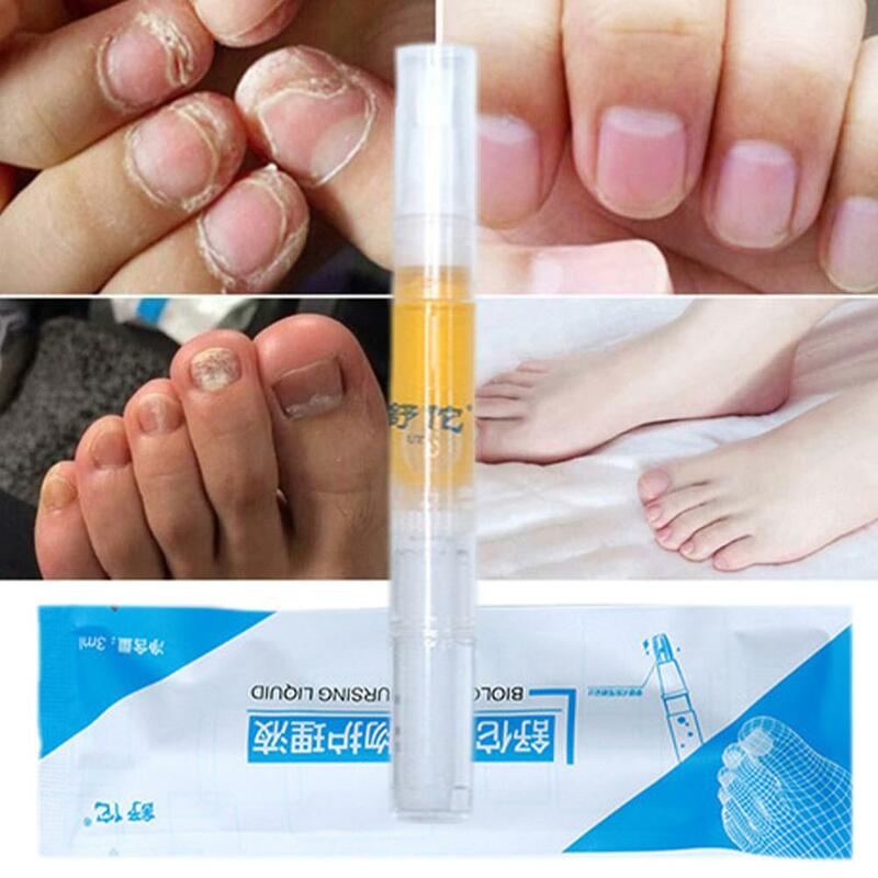1pcs Nail Paronychia Repair Serum Treats Dry Fungal Attack Rough Nails Discoloration Foot Care Health Supplies hot