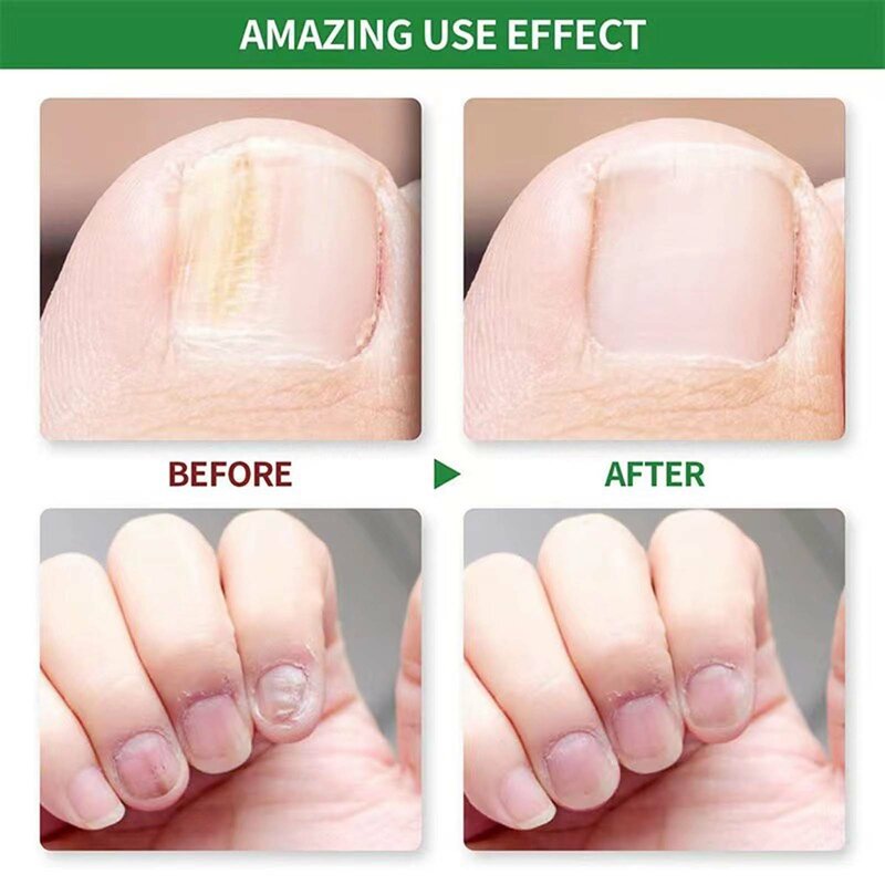 Sérum de soin des ongles pour les orteils, efficace, élimine l'onychomycose, liquide de réparation des ongles, cassé, Conté, fendu et faible, N64.