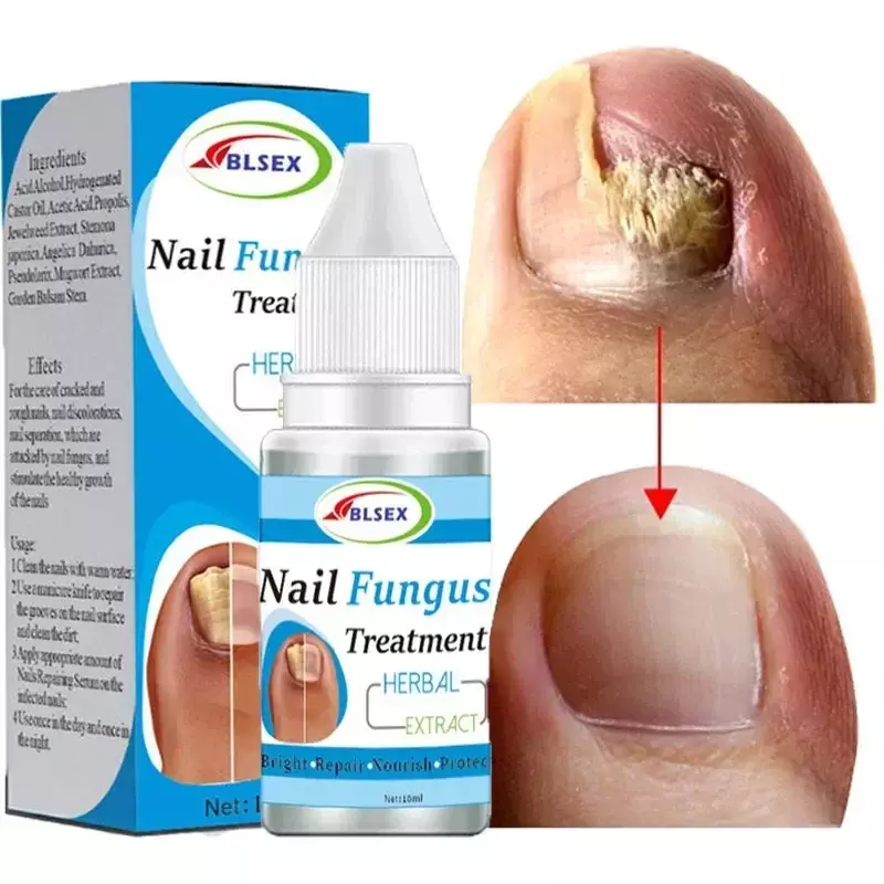 Tratamento do fungo para unhas, Nail Repair Solution, Unhas Repair, Onicomicose, Paroníquia, Anti Infection Toe Nail, Novo