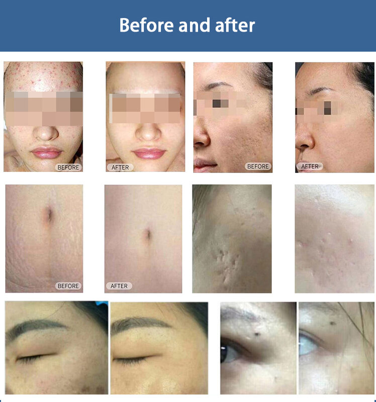 Punkt matrix Haut Schönheit Gesichts Akne entfernen Licht linien tragbare Reparatur Dehnung streifen Schönheit