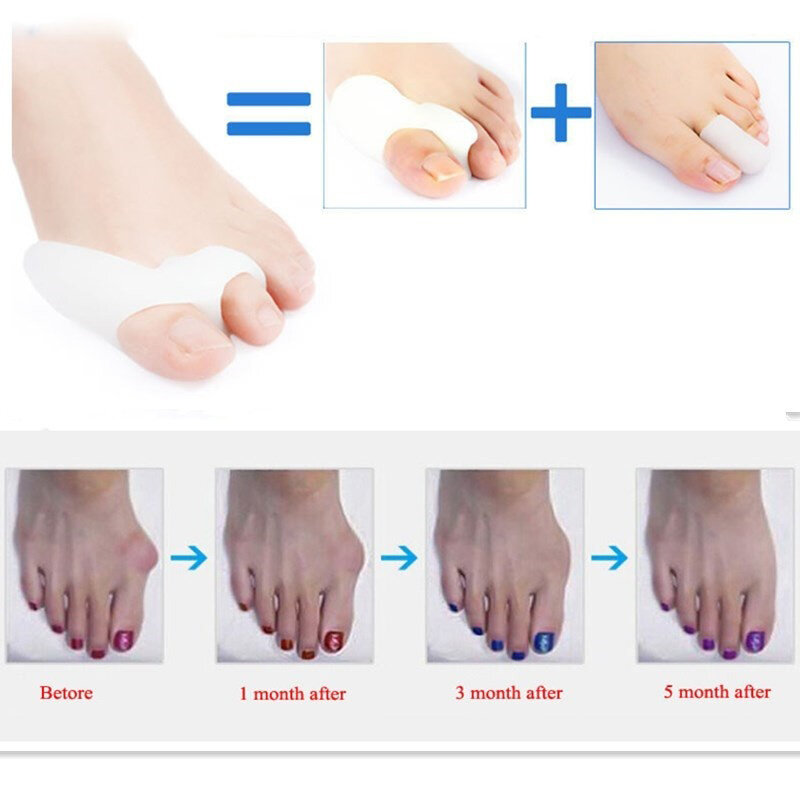 Separador de dedos de silicona para piezas, ortesis ortopédica para juanete, Protector de dedos, alisador y pedicura, 2 orificios