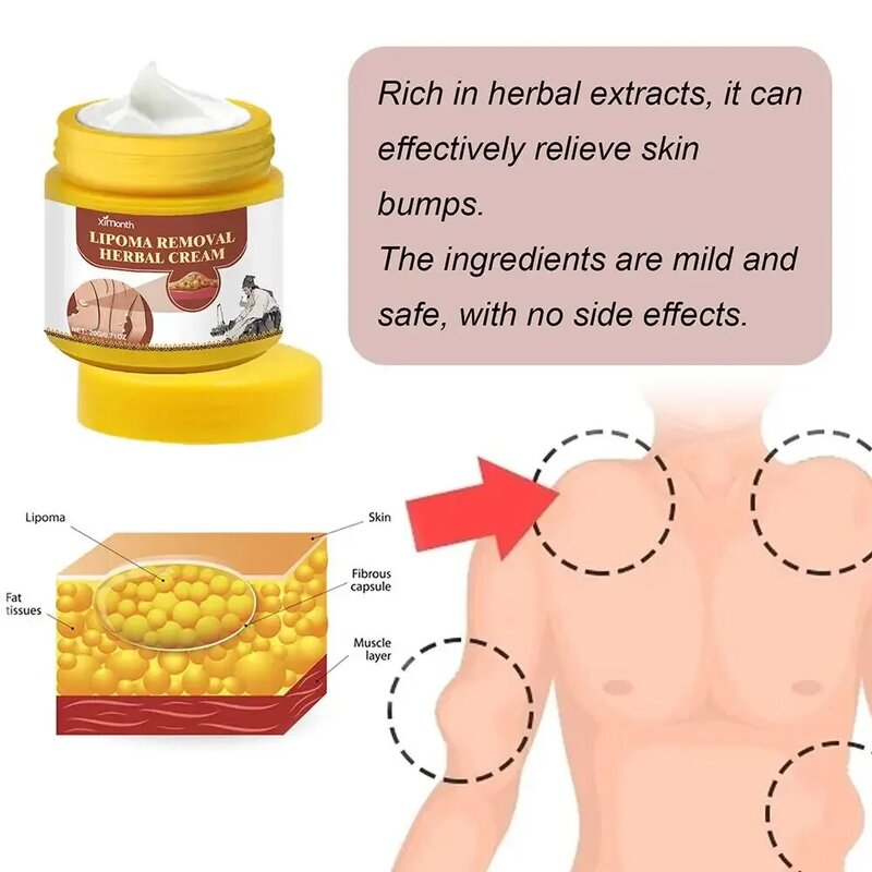 Lipoma Removal Herbal Cream Body Cream Dissolving Fat Easy To Use Herbal Lipoma Removal Cream