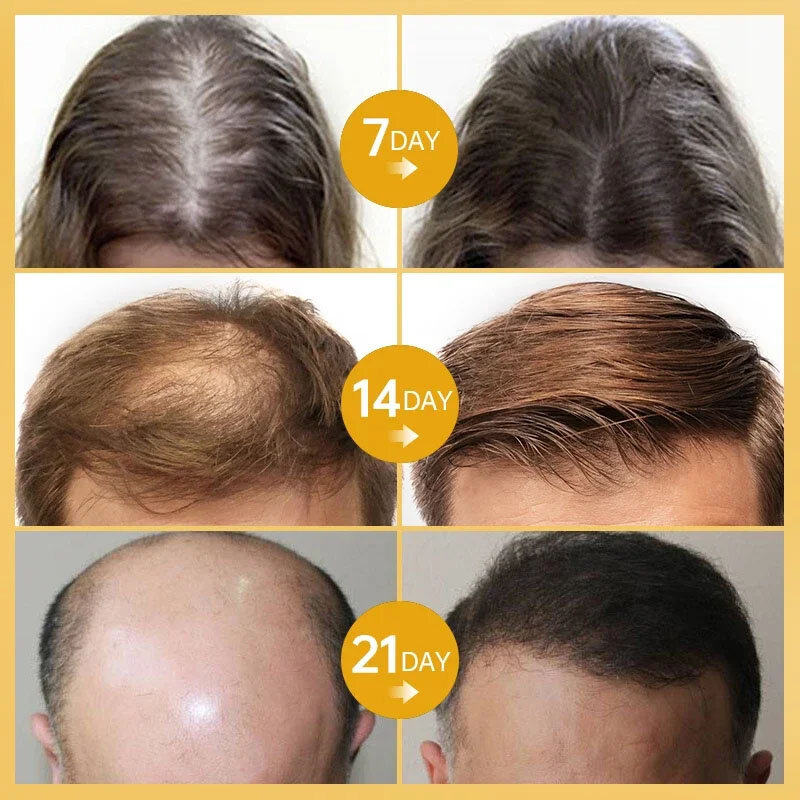 Sérum de croissance des cheveux 7 jours, anti-chute, calvitie, repousse rapide, huile essentielle, réparation des cheveux abîmés, traitement des racines