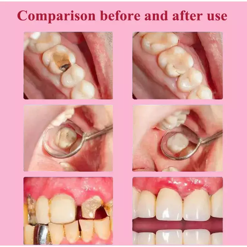 Repair of Cavities Caries Removal of Plaque Stains Decay Whitening Yellowing Repair Teeth Whitening 2023 New toothpaste 120g