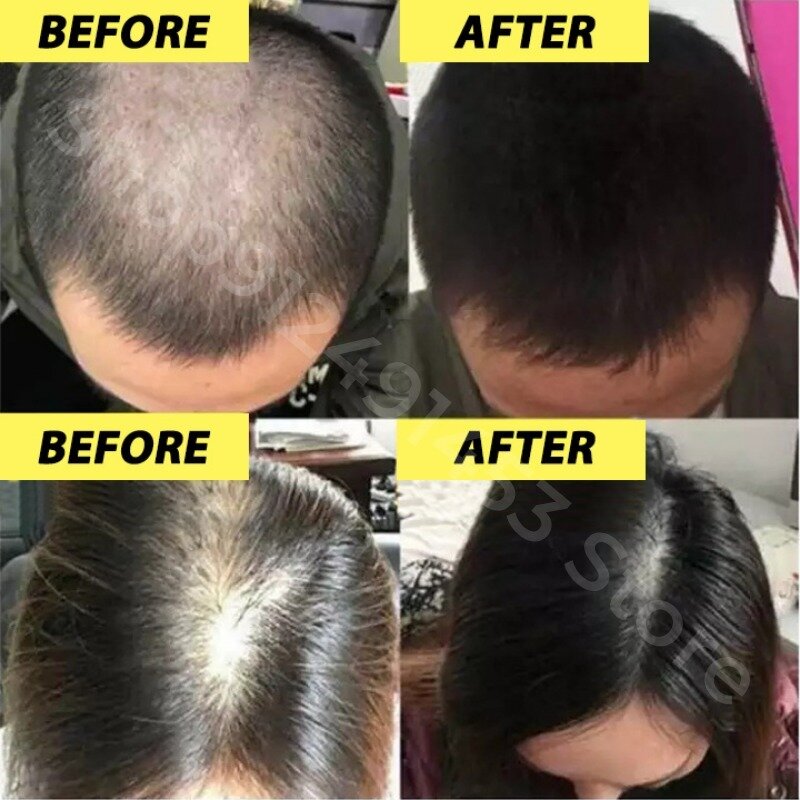 Shampooing anti-chute de cheveux, renforce les racines des cheveux, prévient la perte de cheveux, régénère les cheveux rapidement, épaissit, élimine les pellicules