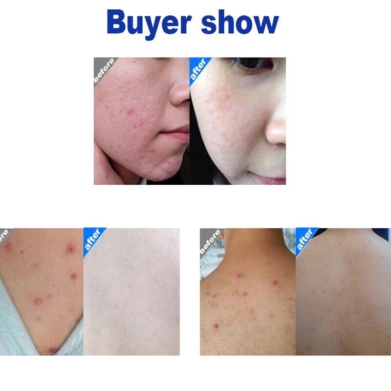 Original Shanghai Sulfur Soap For Bath Oil-Control Acne Eczema Anti Fungus Facial Cheap Whitening Healthy Soaps Eczema