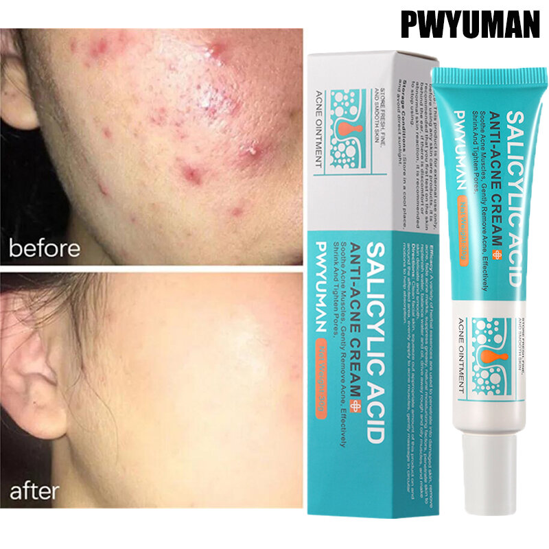 Ácido salicílico Acne Tratamento Creme, Repair Pimple Spots, Limpeza profunda, Poros encolhendo, Anti-acne Oil Control Hidratante, Cuidados com a pele