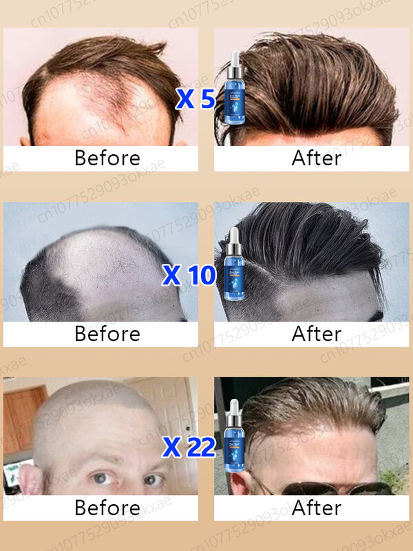 Produtos de Óleo Essencial de Crescimento de Cabelo Rápido e Eficaz Tratamento de Reparo de Calvície Anti Alopecia Seborreica Hereditária Perda de Cabelo Para Homens e Mulheres