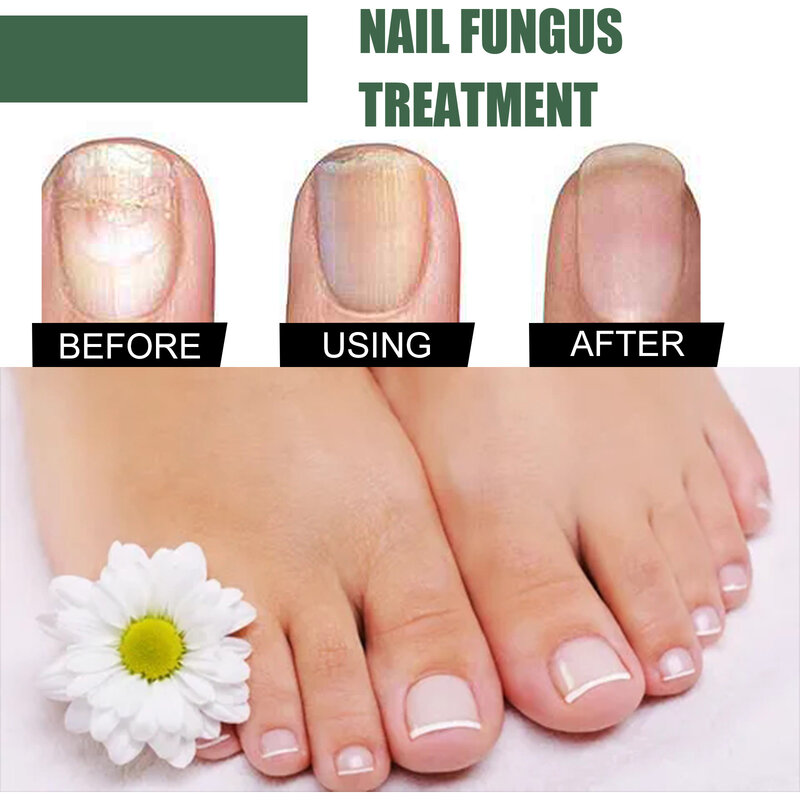 50ml Nail Fungus Remover Mycoses Remedy Foot And Hand Cream For Nail Repair Athlete'S Foot Cure Gray Nail Solution