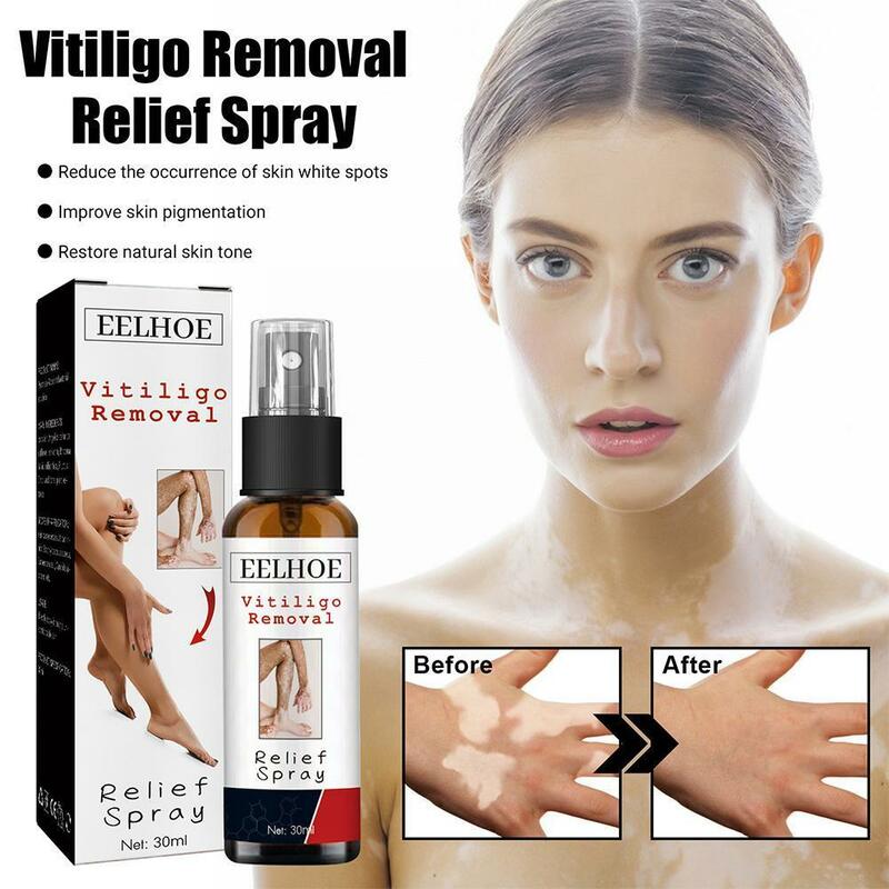 Spray para aliviar el Vitiligo, líquido hidratante para la piel, repara la cara y las manchas del cuerpo, color blanco, R2U4, 30ml