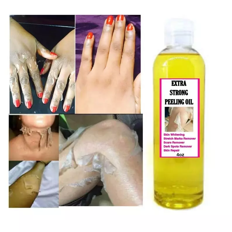 110ml Extra Strong Yellow Peeling Oil Whitening Peeling Oil Lighten Elbows Knees Hands Melanin Even Skin Tone and Whiten Skin